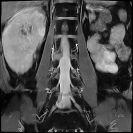 腰椎椎間板ヘルニア正面MRI