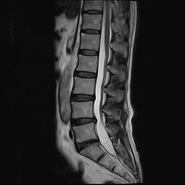 腰椎椎間板ヘルニア側面MRI